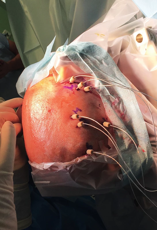 Intracerebrální EEG elektrody krátce po implantaci
(11letá pacientka s farmakorezistentní epilepsií pravého
frontálního laloku na podkladě FCD II. typu).<br>
Fig. 2. The intracerebral (depth) EEG electrodes shortly after
implantation (11-y old girl with refractory right-sided
frontal-lobe epilepsy conditioned by FCD II).
