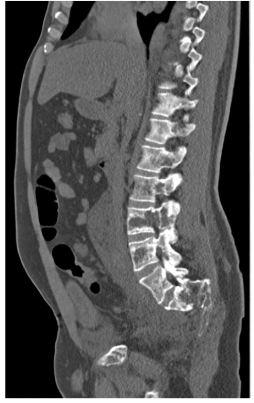 CT scan (sagitální rovina), kostní okno – osteolytické změny
skeletu LS páteře