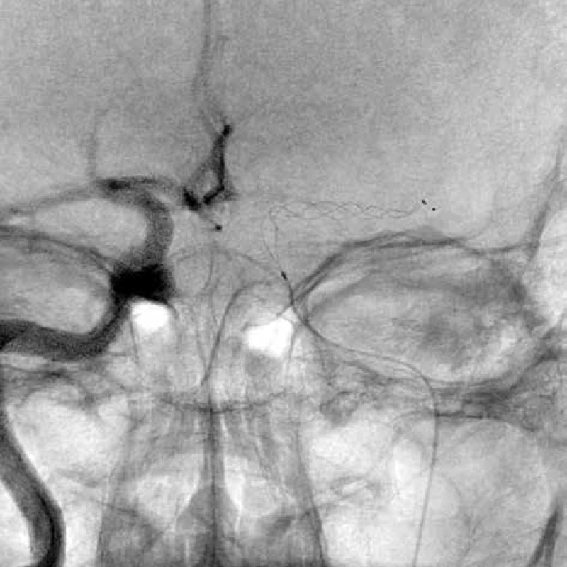 Stent retriever v M1 arteria cerebri media vlevo<br>
Fig. 1: Stent retriever in the M1 part of left middle cerebral
artery