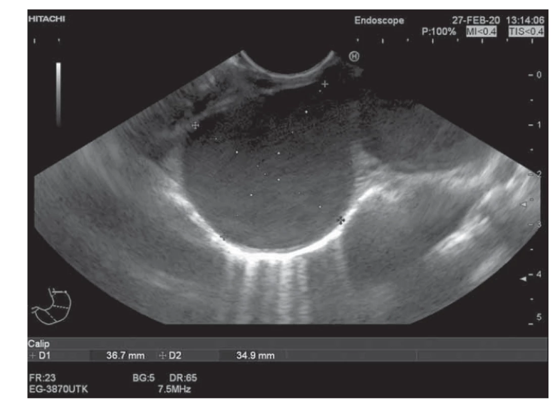Duplikačná cysta ezofágu: EUS obraz.<br>
Fig. 1. Duplicative esophageal cyst: EUS image.