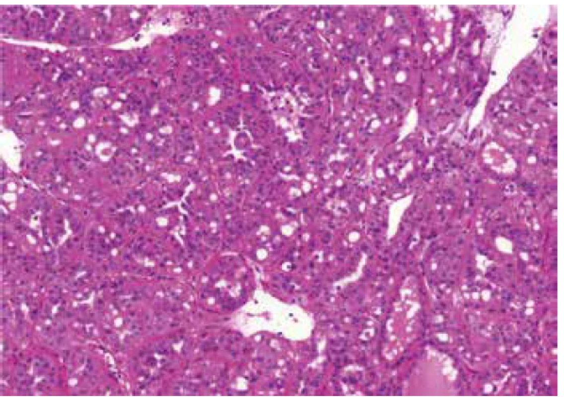 Cribriform pattern in case of renal cell carcinoma mimicking FHRCC
(FH-like RCC). HE 100x