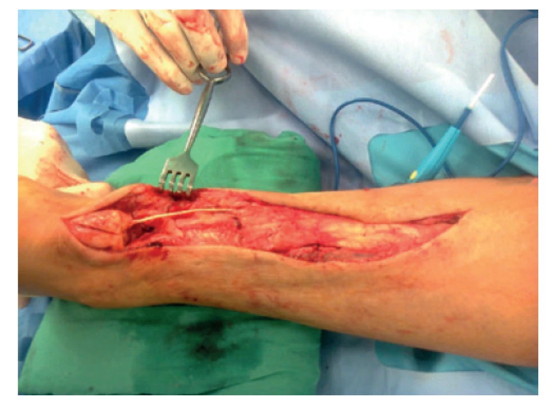 Paramediální esovitý operační přístup se zjištěním
velikosti defektu ve šlaše cca 10 cm<br>
Fig. 6: Paramedial S-shaped surgical approach revealing
a tendon defect of approximately 10 cm