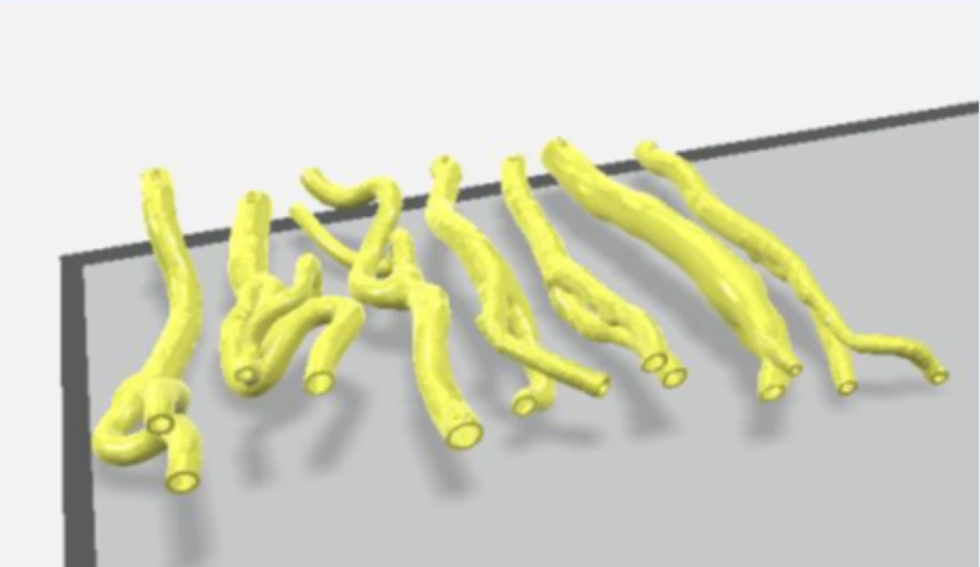 3D rekonstrukce karotického řečiště z CT angiografických snímků (7 pacientů)<br>
Figure 1. 3D reconstruction of the carotid artery from CT angiographic images (7 patients)