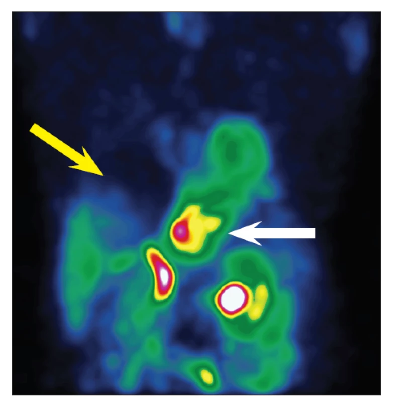 Snímek hrudníku, přední projekce. Patrná velká kulatá fotopenická
oblast v oblasti jater (žlutá šipka) a významný duodenogastrický
reflux (bílá šipka).