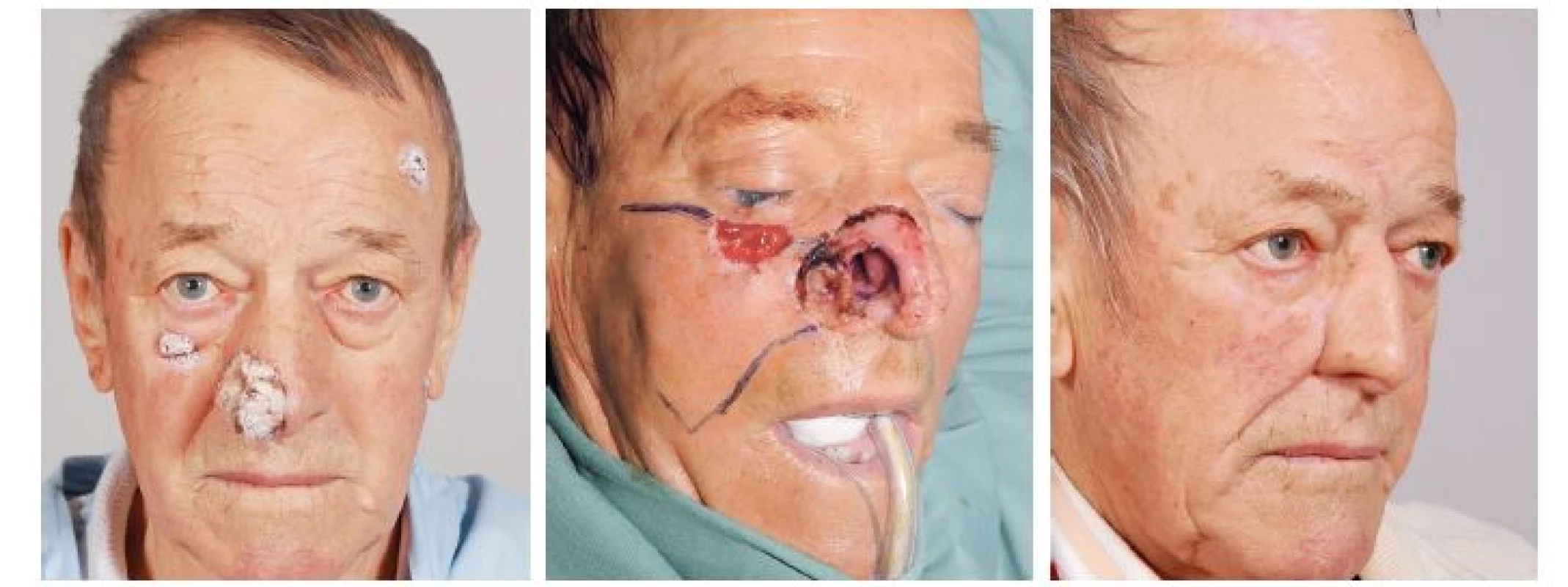 Případ 3 – rozsáhlý basaliom pravé poloviny nosu: A) stav před operací, B) stav po radikální resekci tumoru, C) stav po dokončení
rekonstrukce nosu.