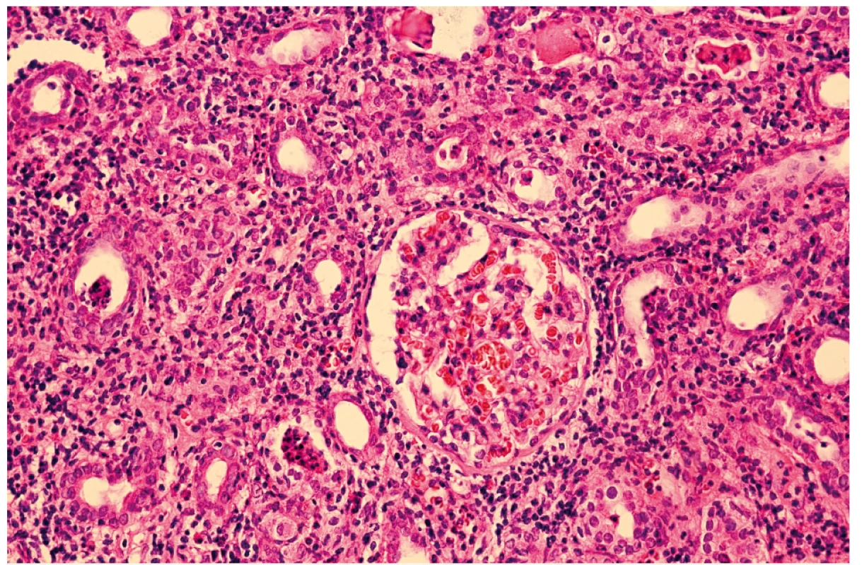 Svetelná mikroskopia obličky u 10-ročného chlapca s TIN – prítomná zmiešaná populácia T- a B-lymfocytov s bohatou
prímesou histiocytov a polymorfonukleárnych leukocytov.<br>
Fig. 1. Light microscopy of kidney in 10 years old boy with TIN – shows mixed population of T- and B-lymphocytes with massive
admixture of histiocytes and polymorphonuclear leukocytes.