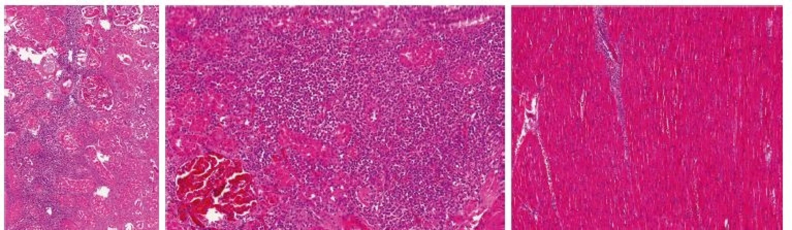 Kazuistika 1– histologický obraz leukemické infiltrace orgánů