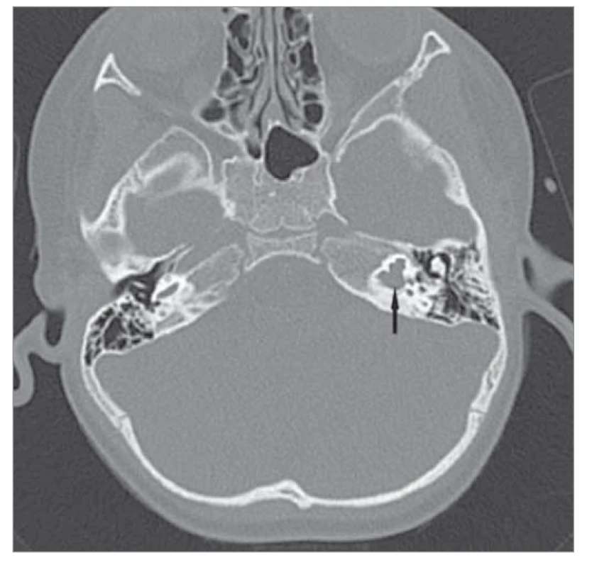 Mondiniho malformace vlevo (označeno šipkou),
CT snímek, axiální projekce.<br>
Fig. 3. Mondini malformation on the left (marked by an
arrow), CT image, axial projection.