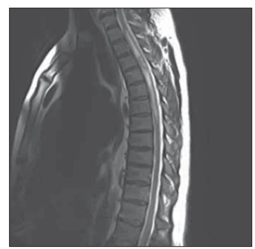 MR hrudní a krční páteře, T2-vážený
obraz, sagitální projekce. Hypersignální
intramedulární ložisko v úrovni
třetího a čtvrtého hrudního obratle s výrazným
edémem míchy.<br>
Fig. 1. MRI of cervical and thoracic spine,
T2-weighted image sagittal projection.
Hyperintense intramedullary lesion at the
level of the third and the fourth thoracic
vertebra with significant spinal cord edema.