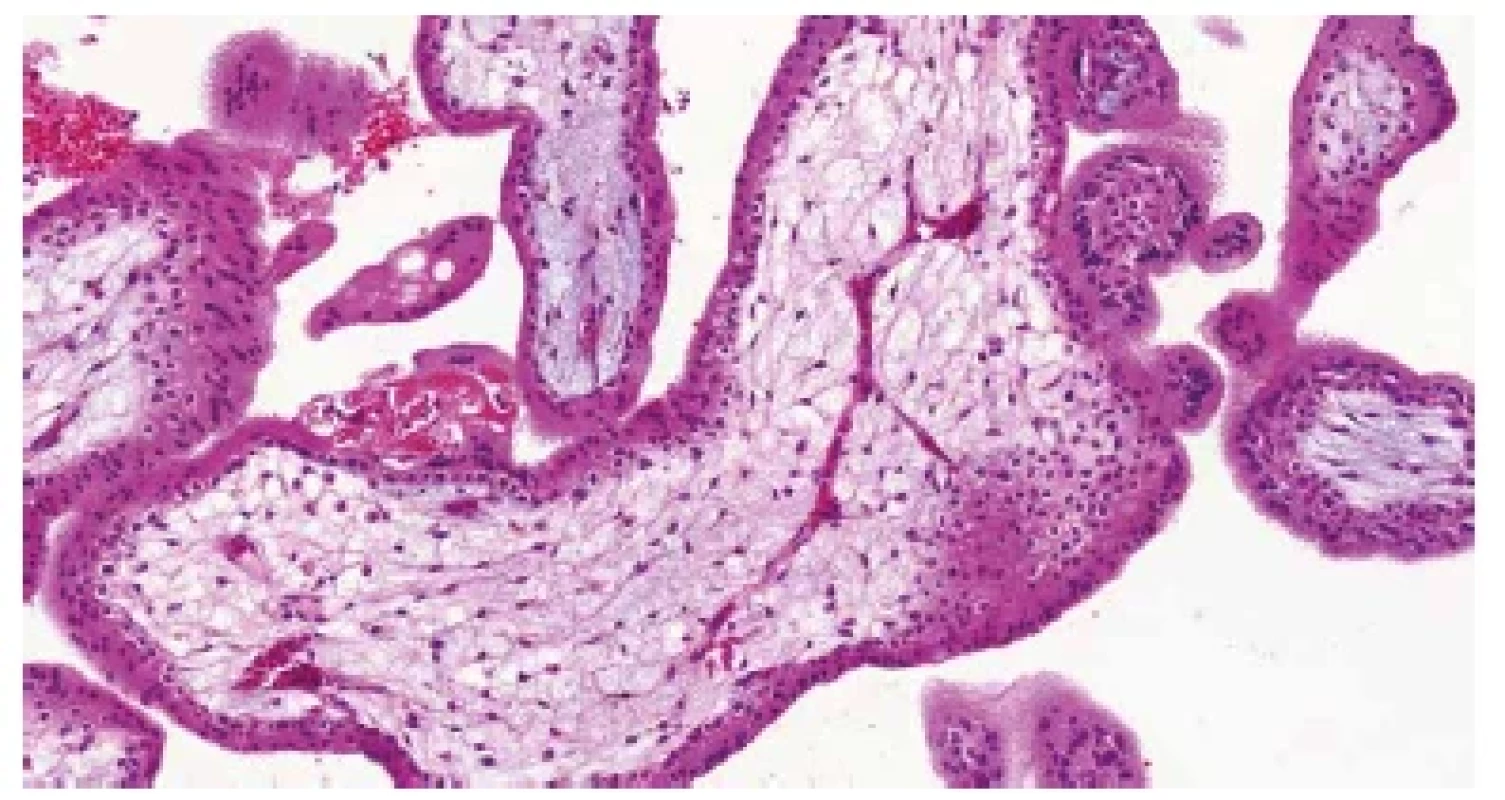Trizomie chromozomu 21. Nepravidelně větvené kapiláry s fetálními
erytroblasty v luminu (HE, 200x).