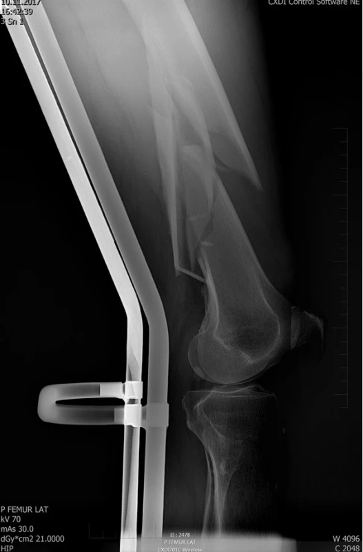Rtg kosti stehenní vpravo u zraněného s nálezem
kominutivní zlomeniny diafýzy