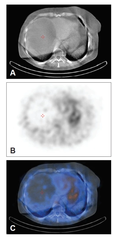 Hybridní zobrazení SPECT/ low dose CT (A – CT obraz,
B – SPECT obraz, C – fúze obou obrazů). Na transverzálním CT
řezu je patrné kulaté hypodenzní ložisko v játrech korespondující
s fotopenickou oblastí na transverzálním SPECT řezu.