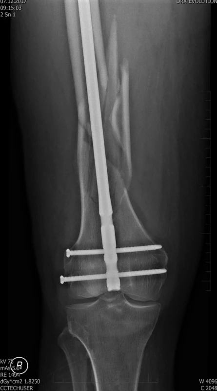 Pooperační rtg stehenní kosti vpravo
– stav po nitrodřeňové osteosyntéze femuru