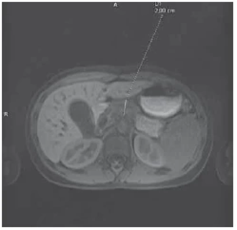 Změněný signál na MR těla pankreatu
s jeho lehkým rozšířením, mírné
rozšíření pankreatického vývodu. <br> 
Fig. 3. Changed signal on MRI of the body
of the pancreas with its slight expansion,
slight expansion of the pancreatic duct.