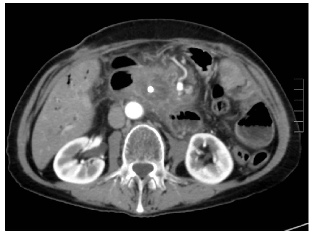 Pancreatic head tumour 3 months after RFA