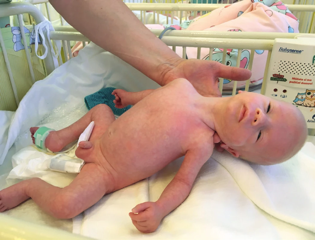 Ťažký centrálny hypotonus u novorodenca
s Praderovej-Williho syndrómom.<br>
Fig. 2. Severe central hypotonus in newborn with Prader-Willi
syndrome.