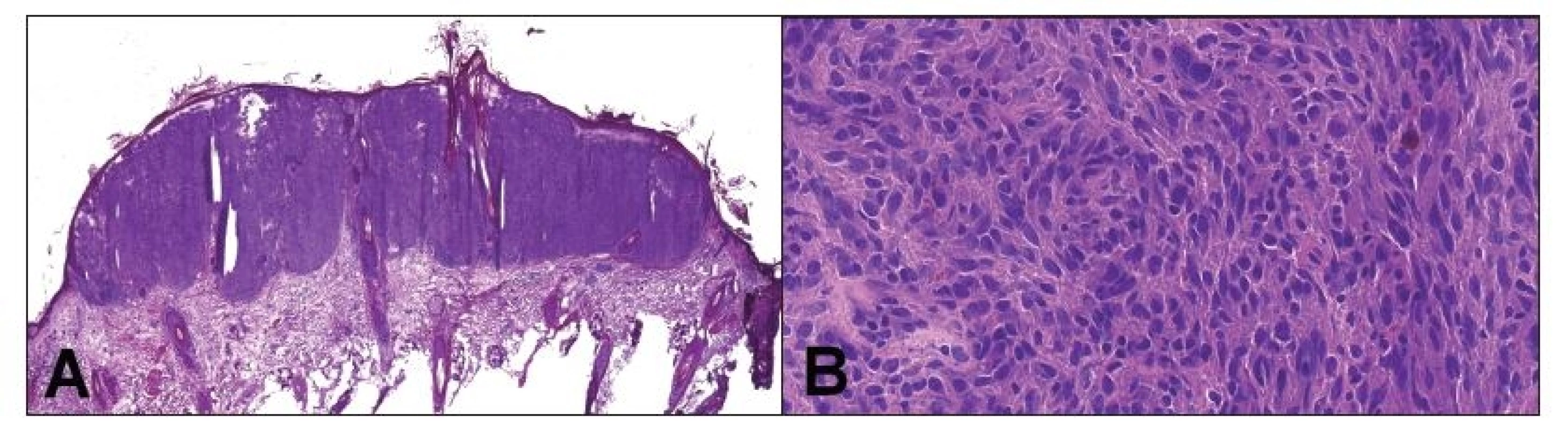 Peroperačné vyšetrenie hlavnej lézie v kapilíciu, ktorá bola klinicky považovaná za skvamocelulárny karcinóm. Jednalo sa
o nodulárne ložisko pod intaktnou epidermis (A). Tumor bol zložený prevažne z pleomorfných vretenitých buniek, s početnými
mitózami. Celkom ojedinele nádorové bunky obsahovali hnedý pigment (B). Peroperačná diagnóza: malígny melanóm.