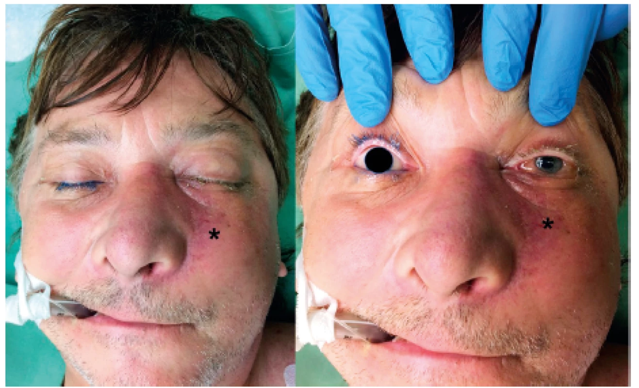 Předoperační lokální nález před radikálním resekčním
chirurgickým výkonem - infiltrace levé tváře (viz *).