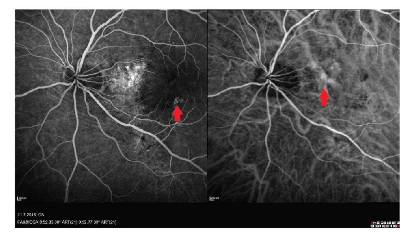 Vlevo snímek fluorescenční angiografie - patrná chorioretinální anastomóza, vpravo
snímek z angiografie s indocyaninovou zelení – patrna makrocéva v papilomakulárním svazku