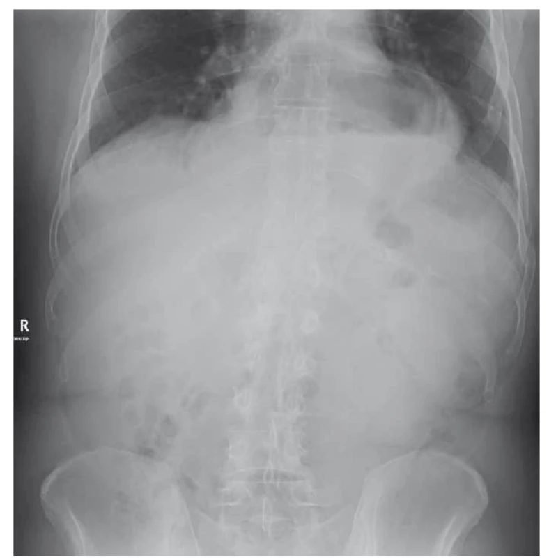 Nativní RTG snímek břicha vstoje, velká hiátová hernie žaludku
s hydroérickým fenoménem (hladinkou).<br>
Fig. 3. Abdominal X-ray, a large hiatal hernia with air-fluid level.