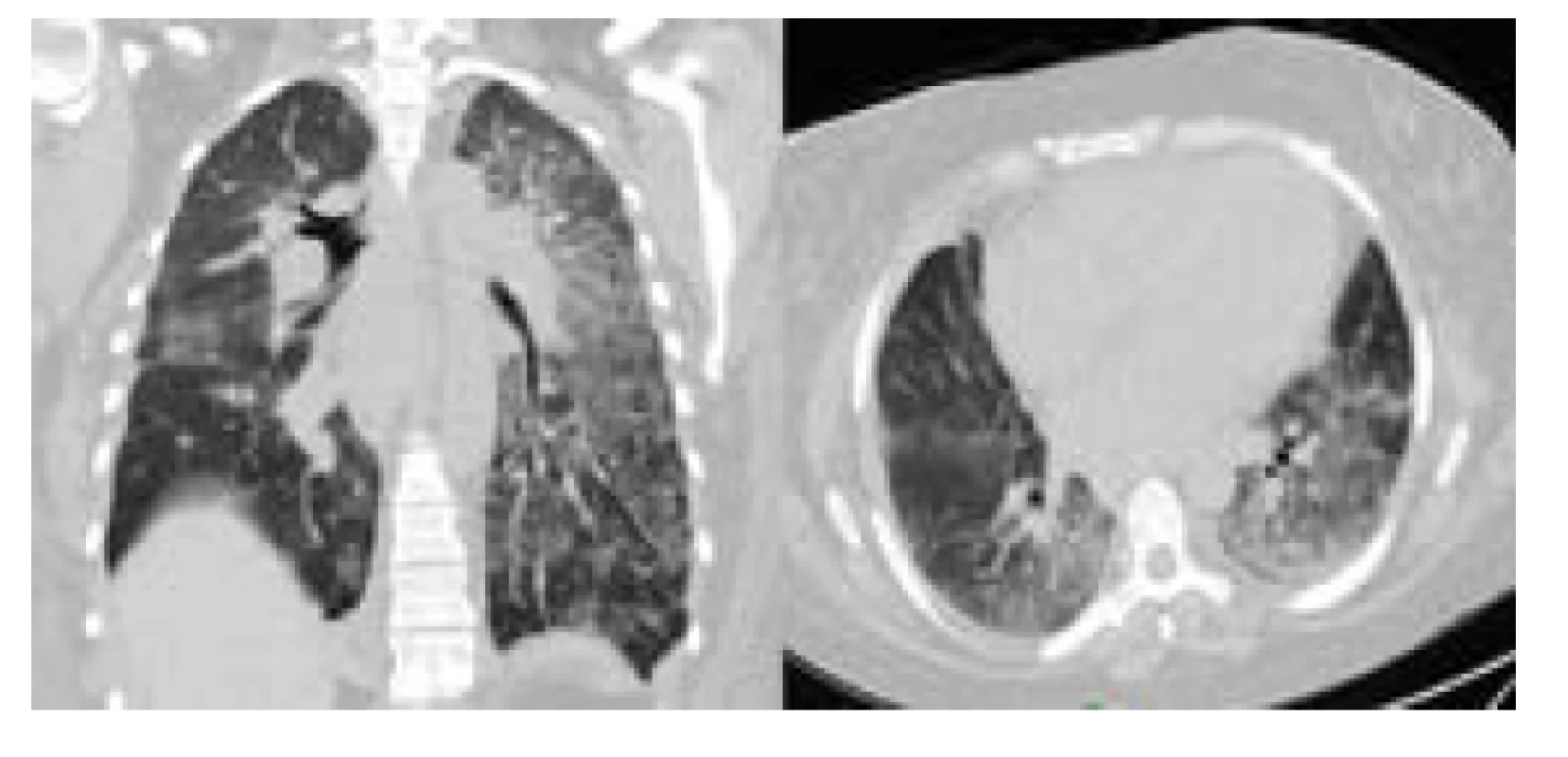 CT hrudníku při přijetí – splývavé konsolidace plic bilaterálně.
Publikováno se svolením KRMN FN Brno