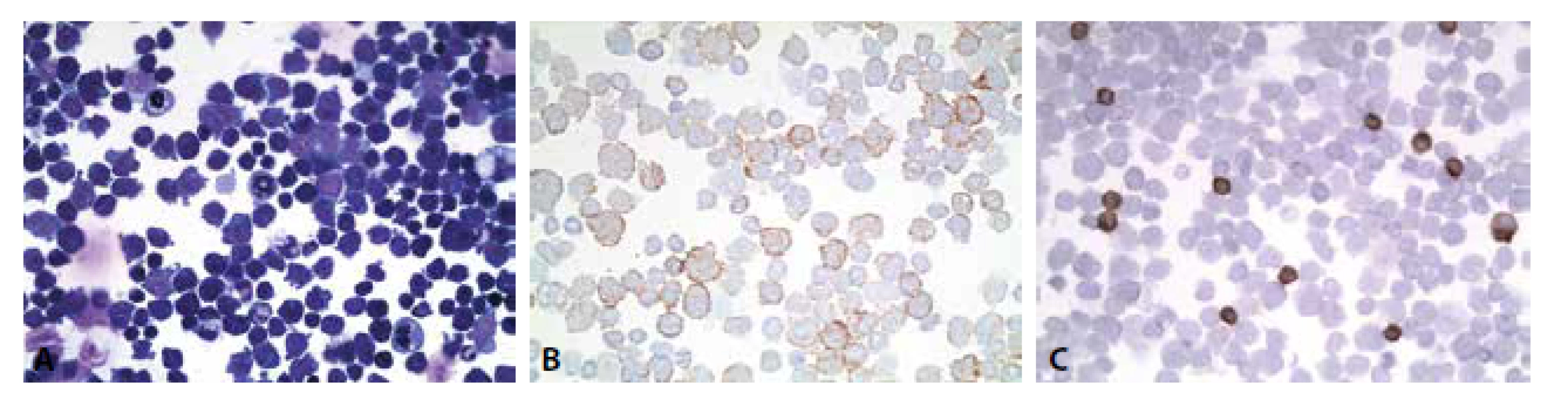 (A) Monomorfní infiltrace dyskohezivními elementy , jejichž morfologie je konsistentní s anamnesticky udaným DLBCL. (B) Pozitivita
CD79a v nádorových buňkách. 400x. (C) Pozitivita CD3 v nenádorových malých lymfocytech. Nádorové buňky negativní. 400x.