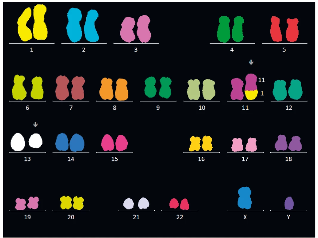 Vyšetření karyotypu nemocného s MDS pomocí mnohobarevné fluorescenční
hybridizace in situ (mFISH)