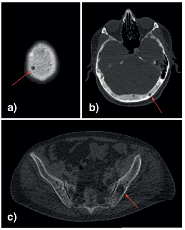 CT, osteolytická ložiska. a), b) kalva, c) pánev