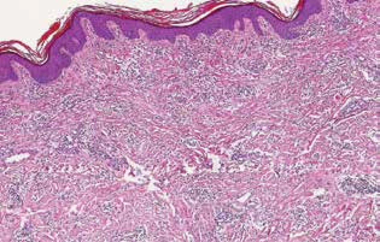Histologický obraz fibrózního uzlu z oblasti pravého
loktu – sklerotizace kolagenního vaziva a  hluboké řídké perivaskulární a intersticiální infiltráty lymfocytů s plazmocyty