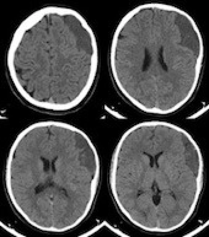The patient`s CT scan at admission showing a stable arachnoid cyst.<br>
Obr. 3. Pacientovo vstupní CT mozku zobrazující stabilní arachnoideální cystu.

