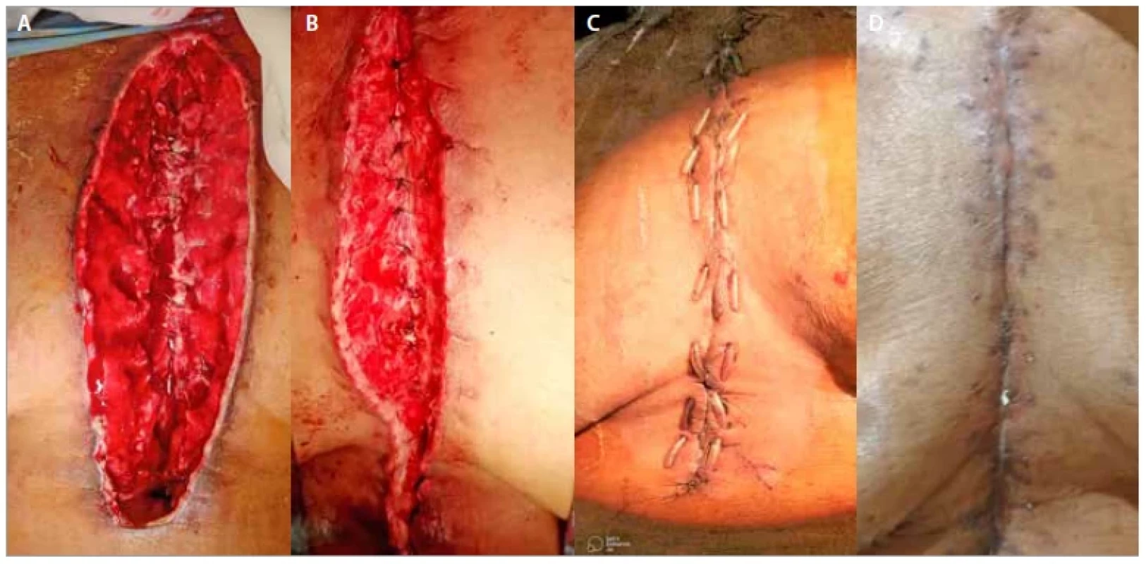 A) Deep sternal wound infection – pre-operatively; B) after bilateral pectoral flap inset; C) day 10 after flap
operation; D day 20 after flap operation.