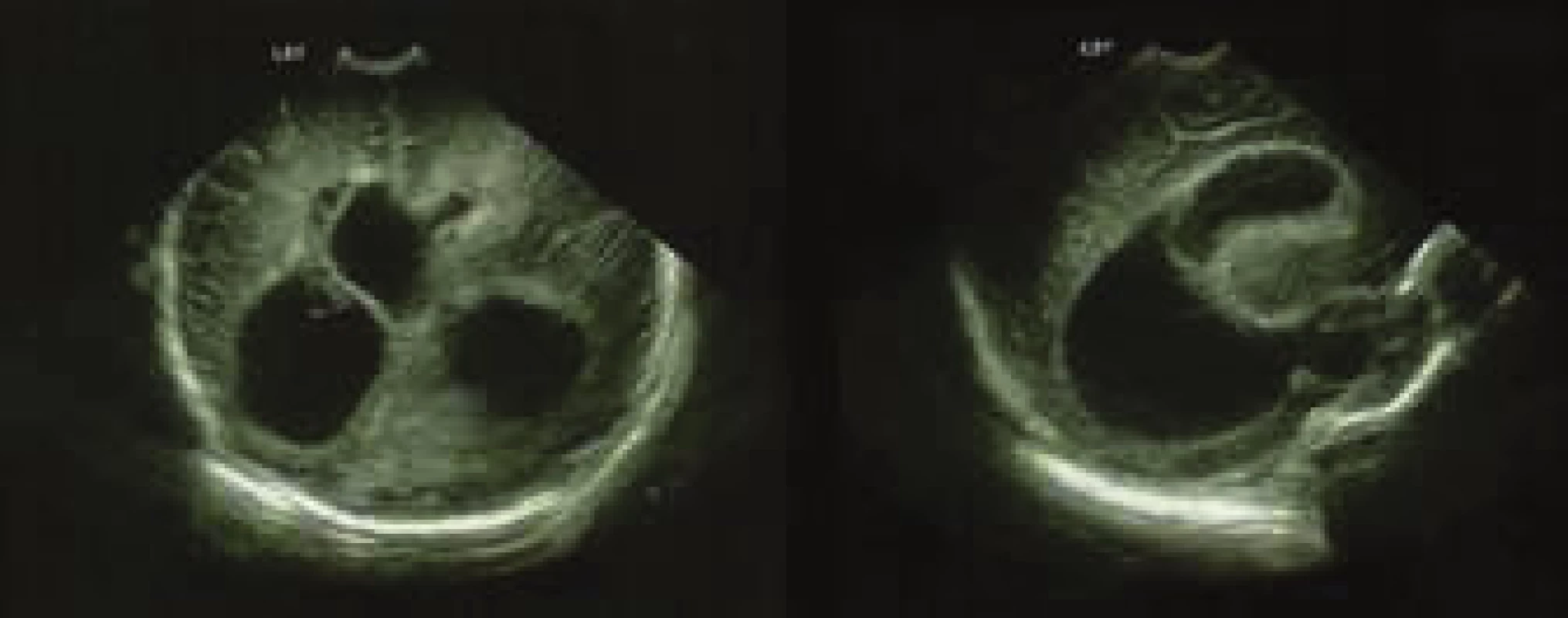 Ultrasonografický nález asymetrie a dilatace postranních
mozkových komor – oboustranně frontálně přítomné hyperechogenity
a patrné známky proběhlé ventrikulitidy.