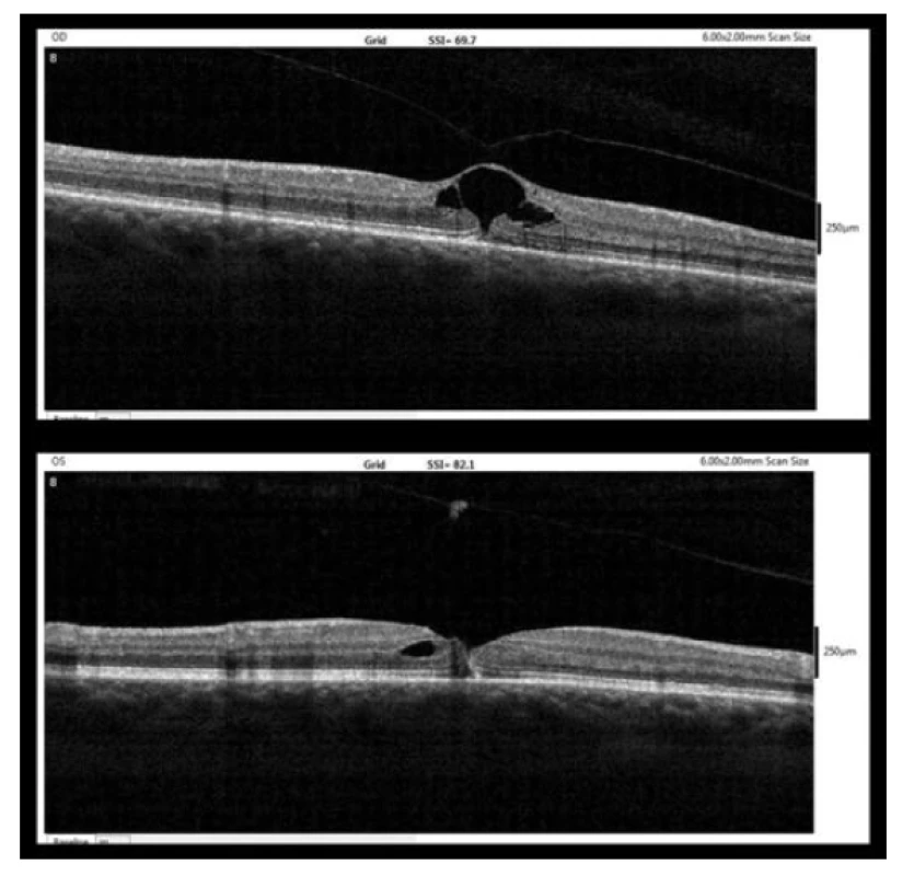 OCT nález týden po diagnóze MD (nahoře – pravé oko,
dole – levé oko)