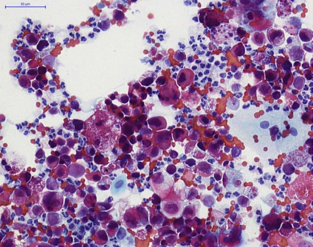 HGUC (barvení PAP) – přítomna je záplava nádorových urotelií, na pozadí četnější neutrofilní granulocyty
(buňky se segmentovaným jádrem) a erytrocyty<br>
Fig. 3. HGUC (PAP staining) – aggregates of neoplastic urothelial cells, with neutrophils (cells with segmented
nuclei) and erythrocytes in the background