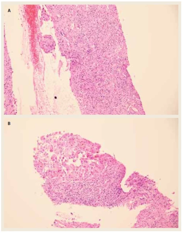 a, b) Transjugulární biopsie jater.  <br> 
Fig. 1. a, b) Transjugular liver biopsy.