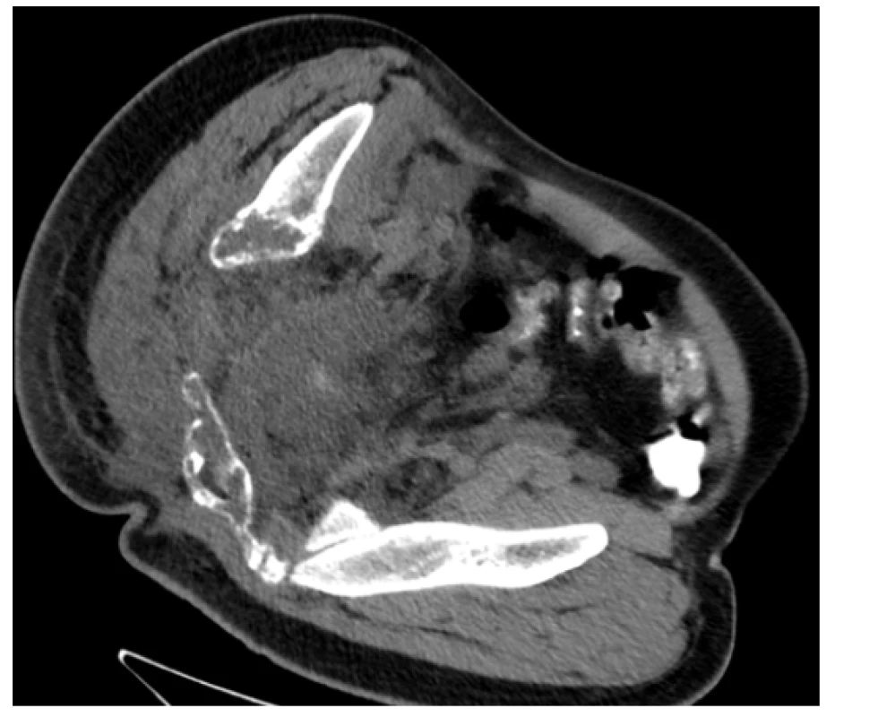 CT scan (axiální rovina) – patologická masa v pánvi, zejména
vpravo s osteolytickými změnami skeletu