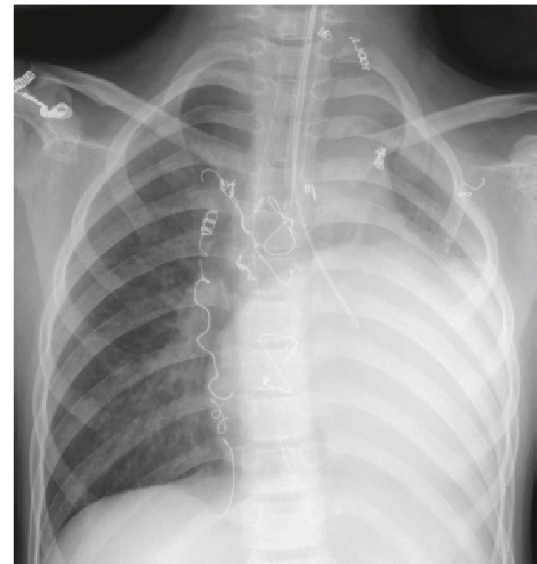 RTG snímka hrudníka zobrazuje obturátor zavedený
do ľavej priedušky (pacient 2).<br>
Fig. 2. Chest X-ray shows endobronchial balloon blocker in
the left bronchus (patient 2).
