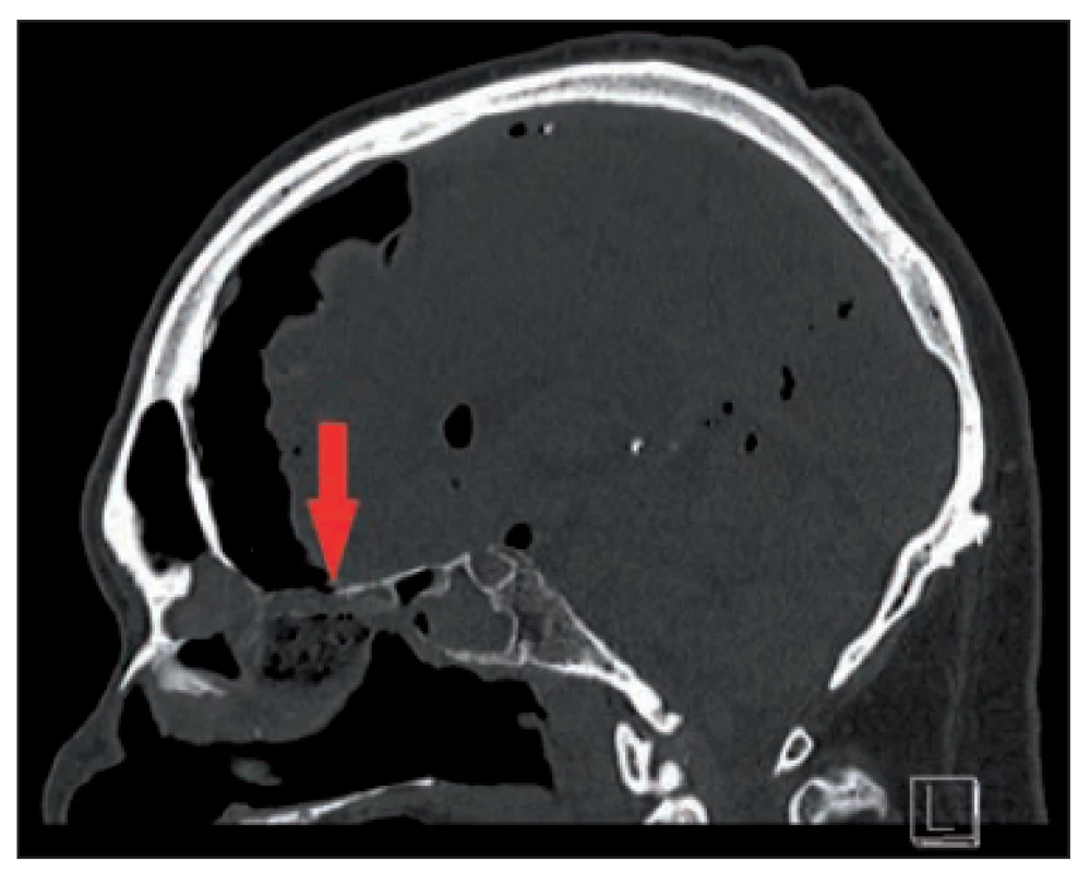 Preoperative CT, the arrow shows
the defect and resulting pneumocephalus.<br>
Obr. 1. Předoperační CT, šipka ukazuje
defekt a následně vzniklý pneumocefalus.