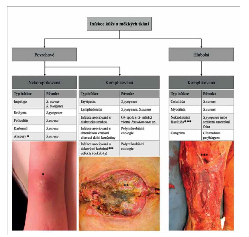 Klasifikace infekcí kůže a měkkých tkání [7]<br>
(foto archiv autorů)<br>
Figure 1. Classification of skin and soft tissue infections [7]<br>
(photo: authors’ archive)